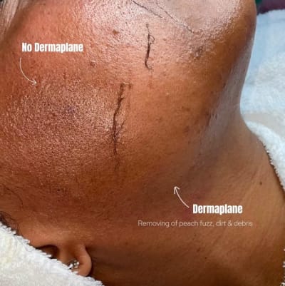 Dermaplaning