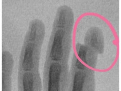 Детская коляска обрубила палец девочке из Подмосковья