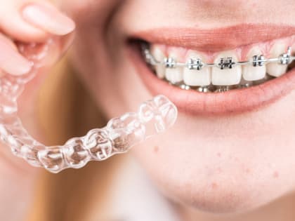 Назван лучший способ исправить прикус