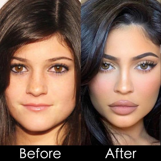 kylie-jenner-avant-apres-chirurgie.jpg