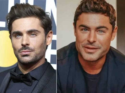 zac-efron-plastic-surgery-before-after-520x390.webp