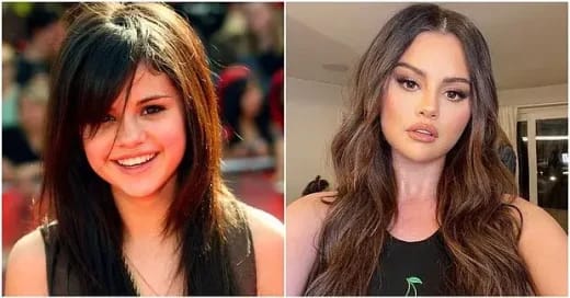 selena-gomez-plastic-surgery-8-1-3-520x272.webp