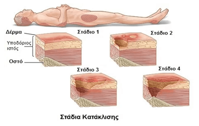 Pressure Ulcer Stages