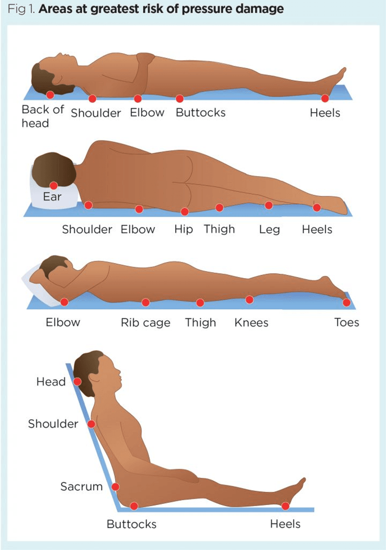 Pressure Ulcer Care