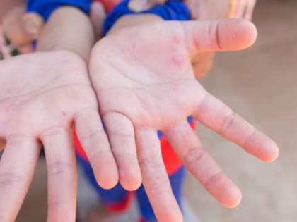 Энтеровирусная инфекция — это группа острых инфекционных заболеваний, которые могут поражать детей и взрослых