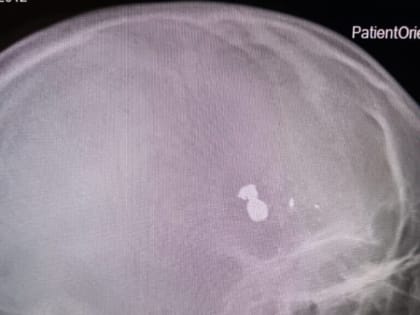 12-летний мальчик получил огнестрельное ранение в Дергачах