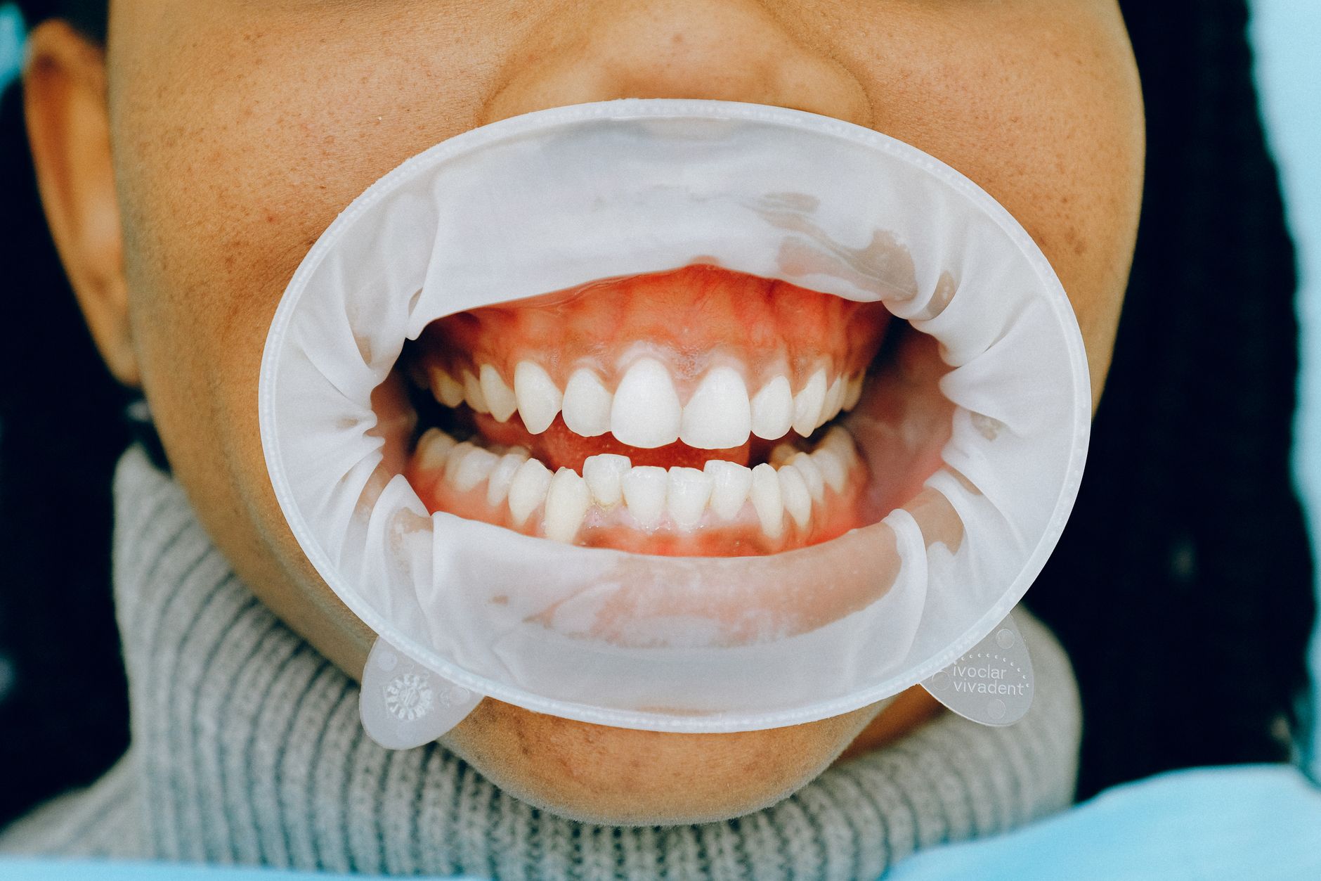 Tartar Can Make Teeth Porous, Really?