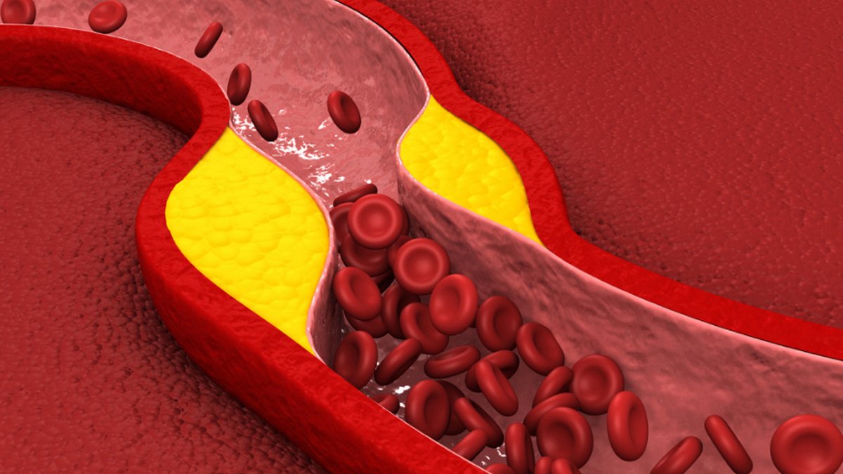 Millions Not Getting Needed Cholesterol Treatment - cholesterol treatment