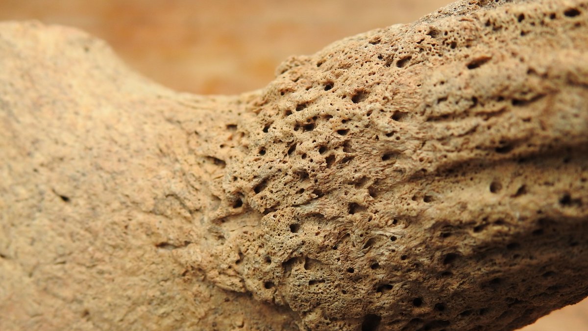 FDA approves new drug for rare bone disease FDA approves new drug for rare bone disease - rare bone disease