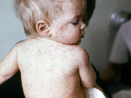 Очаги кори фиксируются в Ростовской области и уже затронули близлежащие к Волгодонску районы