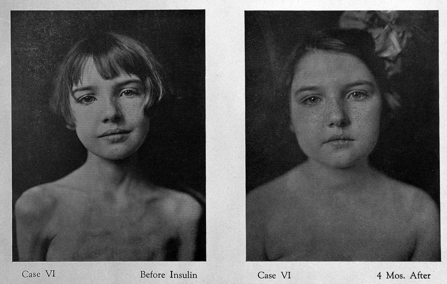 Two black-and-white portraits of the same girl side by side. On the left she is gaunt with visible collarbones, labelled Case VI Before Insulin. On the right her face is fuller and she wears a hair ribbon, labelled Case VI 4 Mos. After.