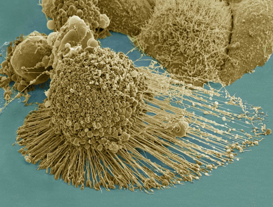 Colourised electron micrograph of a round, bumpy cancer cell covered in small blebs, with long thin filaments fanning out across a blue-green surface.