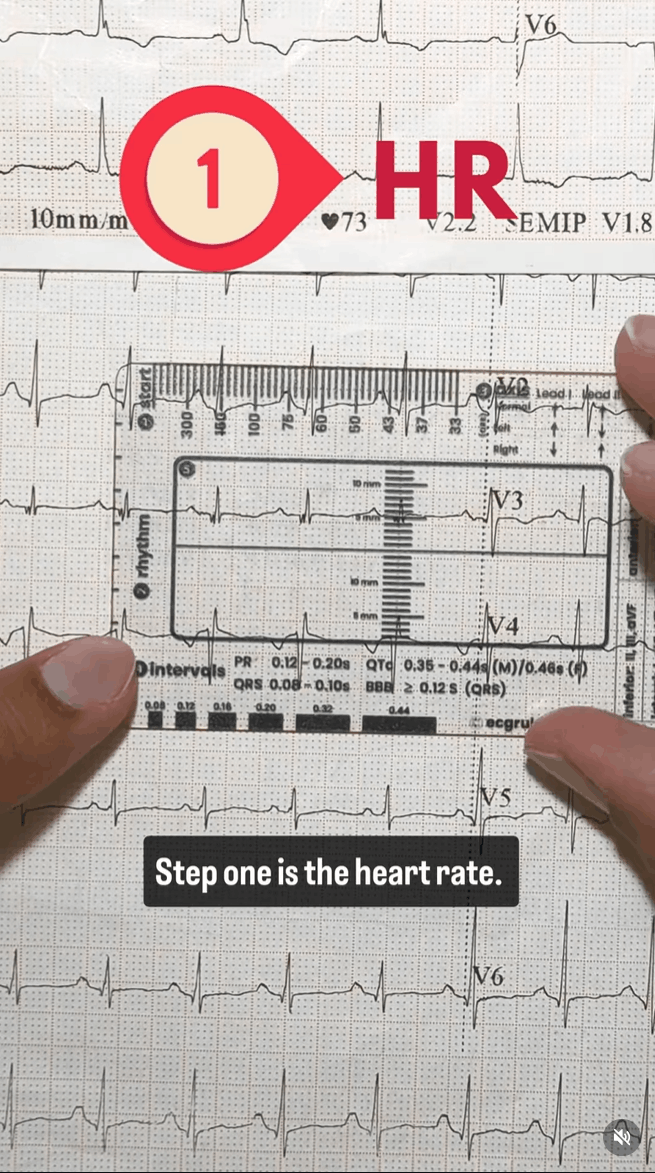 Using An Ecg Ruler ECG Ruler – The Original 5-Step Pocket ECG Interpretation Tool | Buy on ...