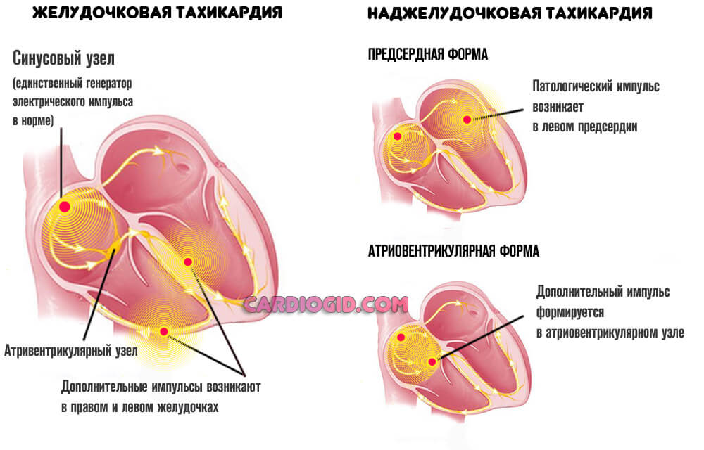 Микроинфаркт признаки