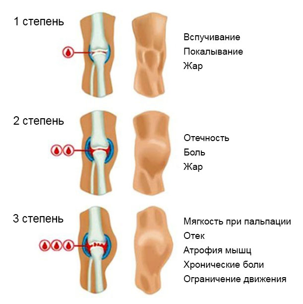 Закрытый перелом коленного сустава карта вызова