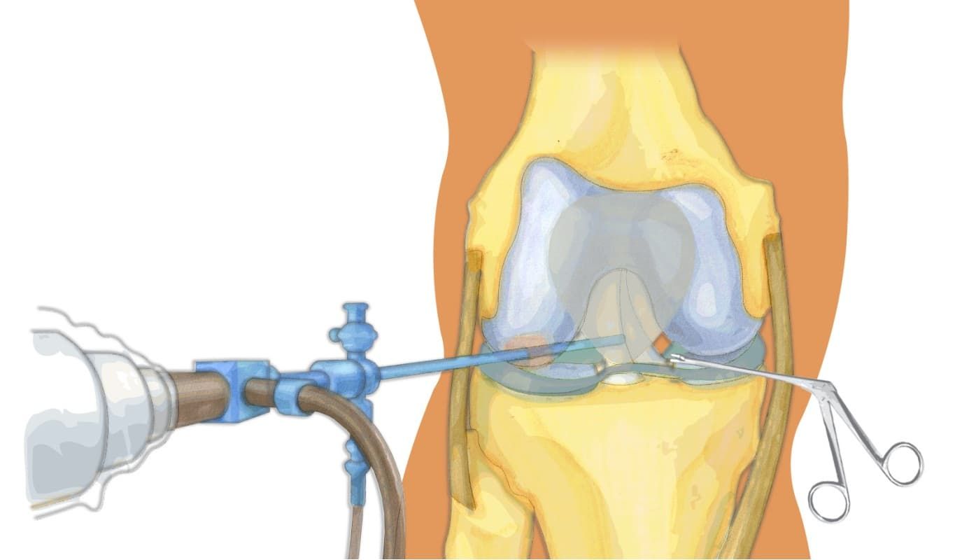 Восстановление мениска колена. Операция артроскопия коленного. Артроскопическая резекция мениска. Артроскопия коленного сустава связки. Операция артроскопия коленного сустава.