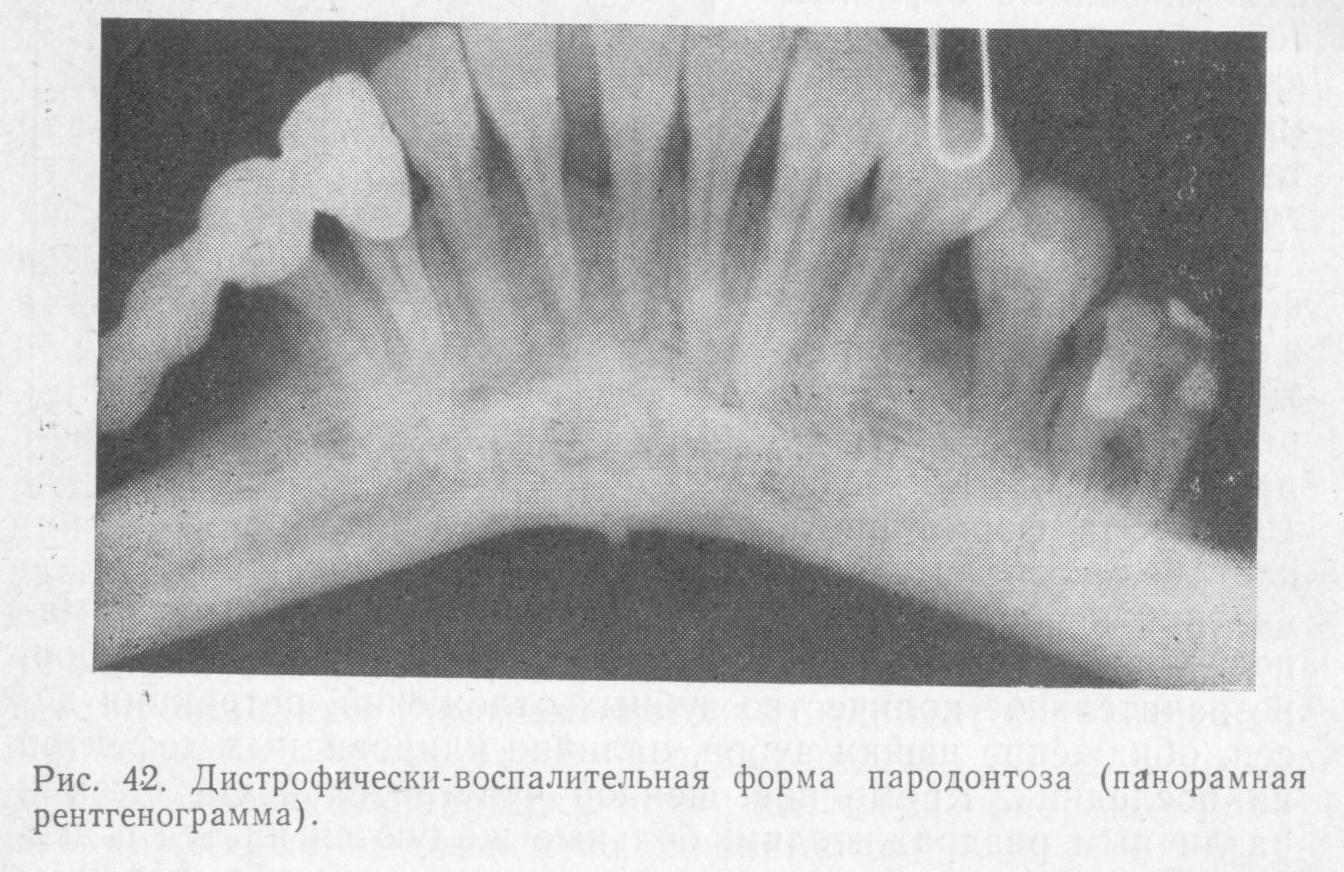 Пародонтит рентгенологическая картина