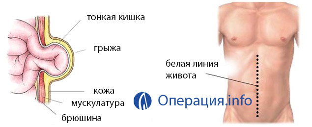 Эпигастральная вентральная грыжа. Пластика грыжи по сапежко. Грыжа белой линии живота. Грида белой линии живота. Грыжа белая линия живота после операции.
