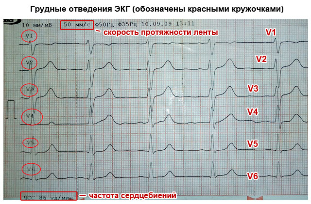 Как прочитать кардиограмму сердца самостоятельно нормы у взрослого по фото