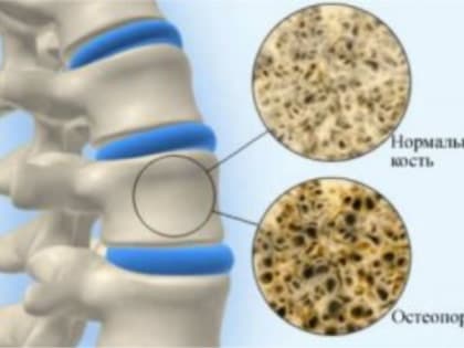Денситометрия. Определение плотности костной ткани (диагностика остеопороза)
