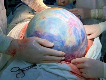Нижегородские хирурги удалили гигантскую опухоль яичника