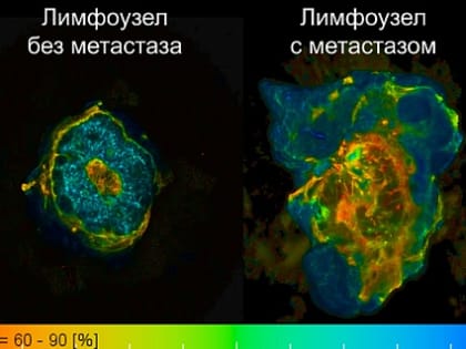 Ученые ПИМУ разработали метод диагностики лимфоузлов при раке молочной железы