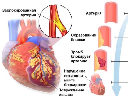 Предотвратить инфаркт