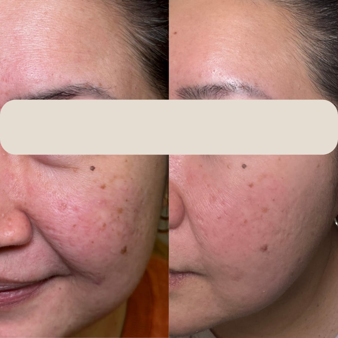 Polynucleotides For Acne Scarring Before and After