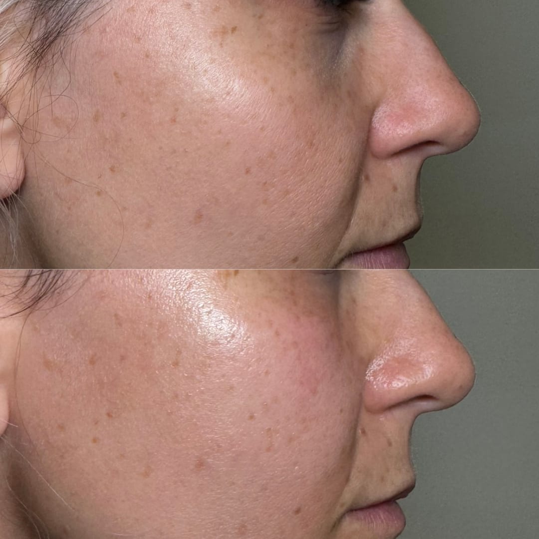 Mid Face Dermal Filler Before and After