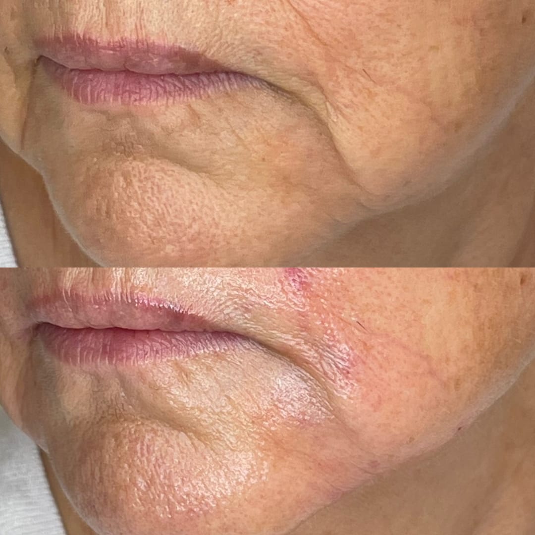 Marrionette Line Dermal Filler Before and After