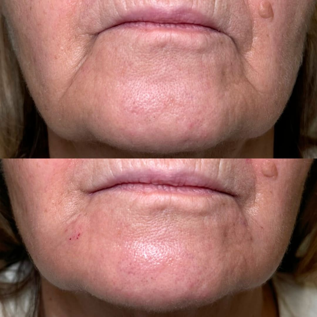 Marrionette Line Dermal Filler Before and After