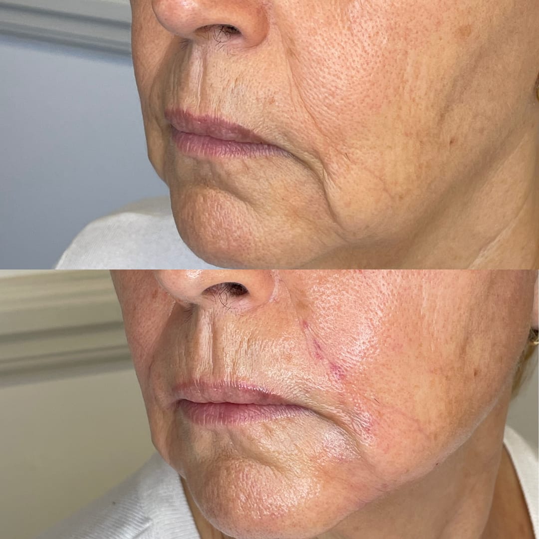 Marionette Line Dermal Filler Before and After