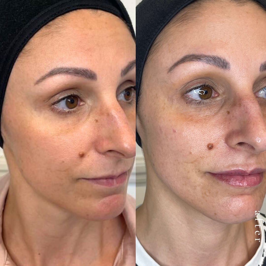 Lip And Mid Face Filler Before and After