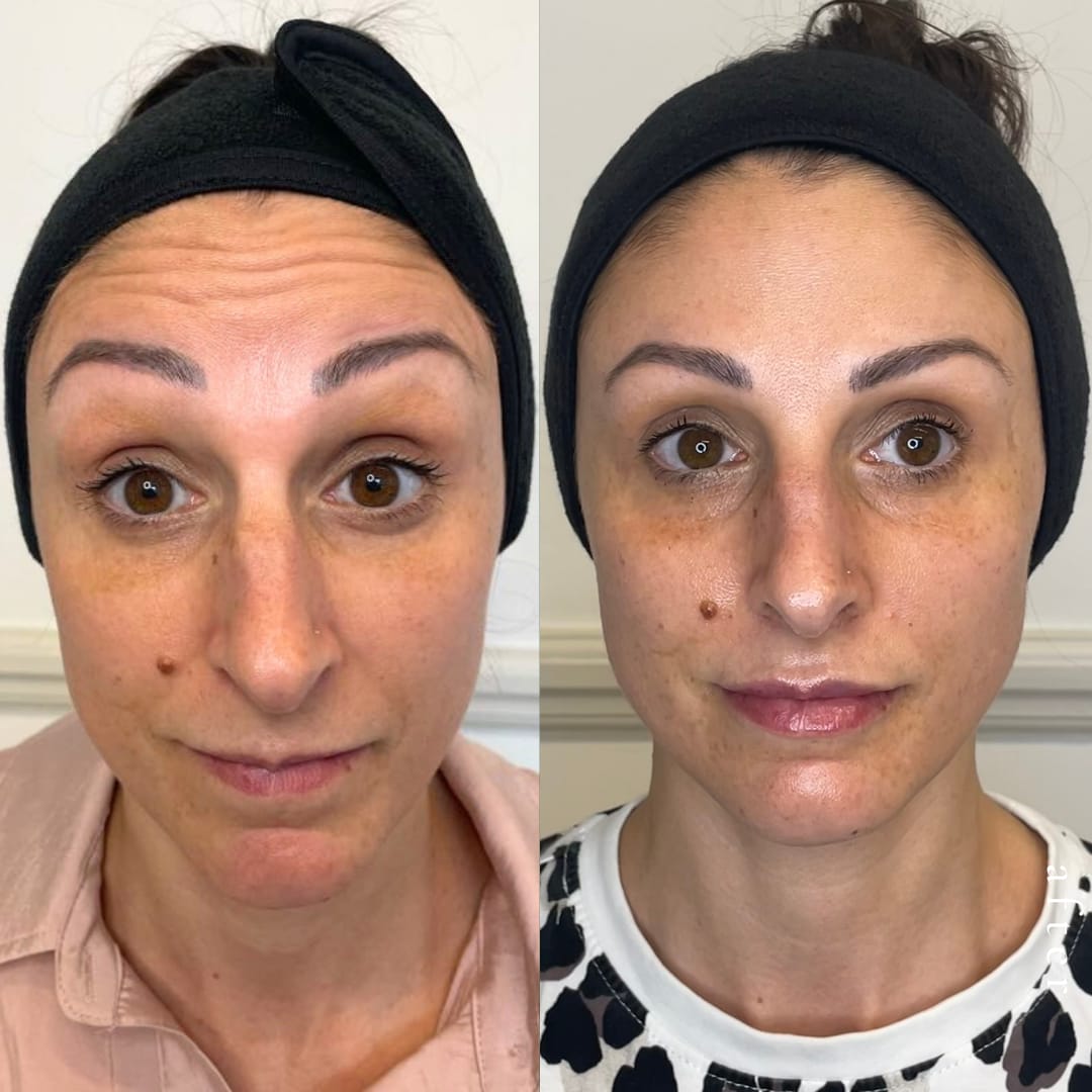 Full Face Treatment Before and After