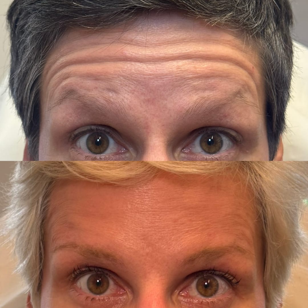 Forehead Line Relaxation Before and After