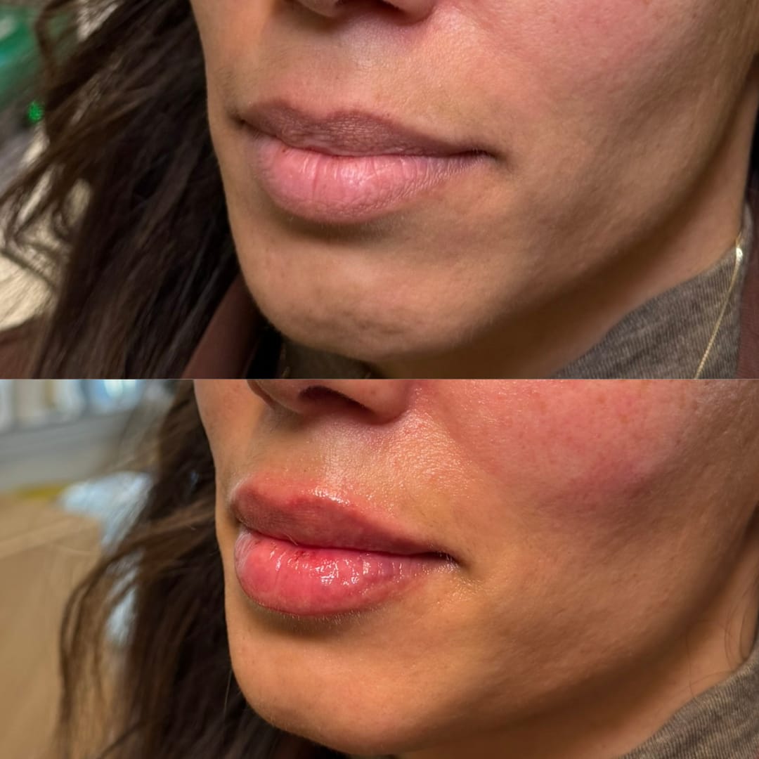 Lip Rejuvenation Before and After