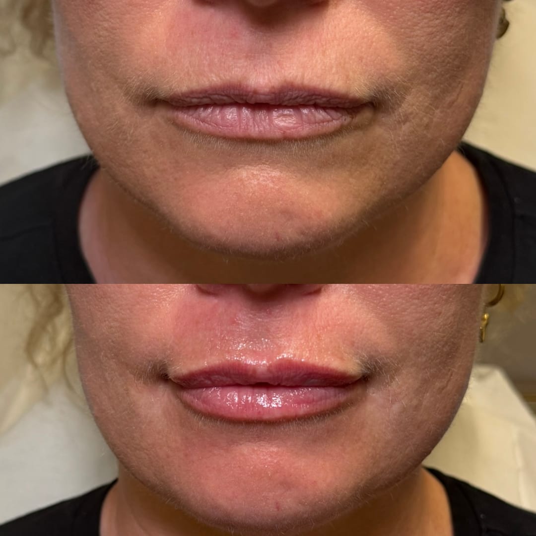 Lip Rejuvenation Before and After