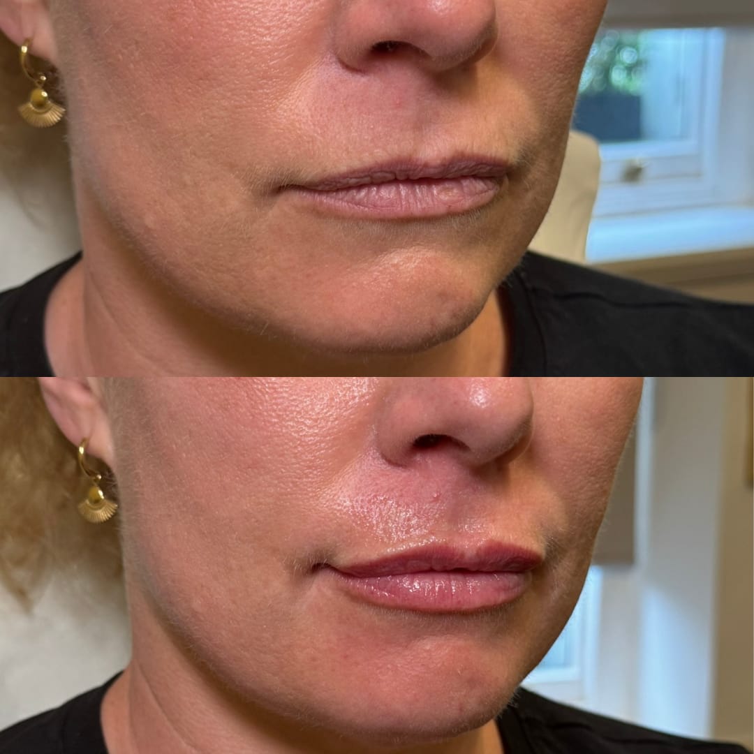 Lip Rejuvenation Before and After