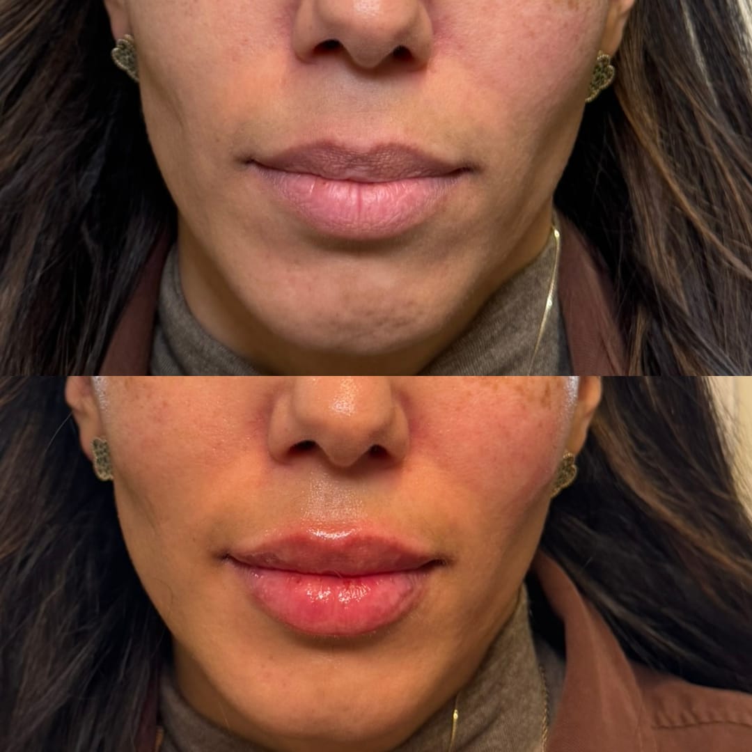 Lip Rejuvenation Before and After