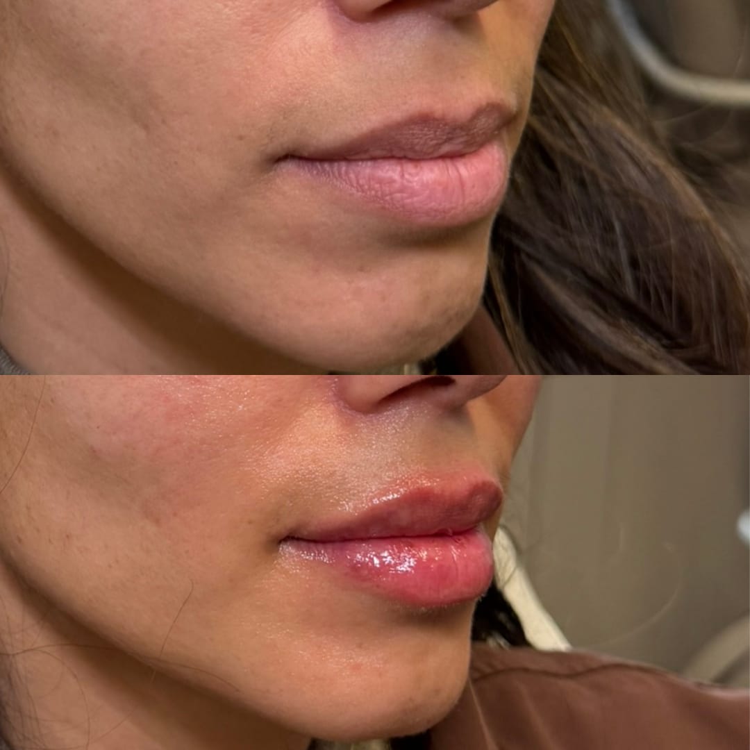 Lip Rejuvenation Before and After