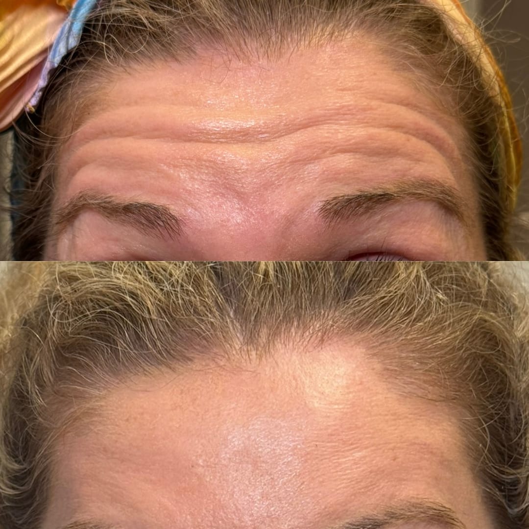 Forehead Line Relaxation Before and After