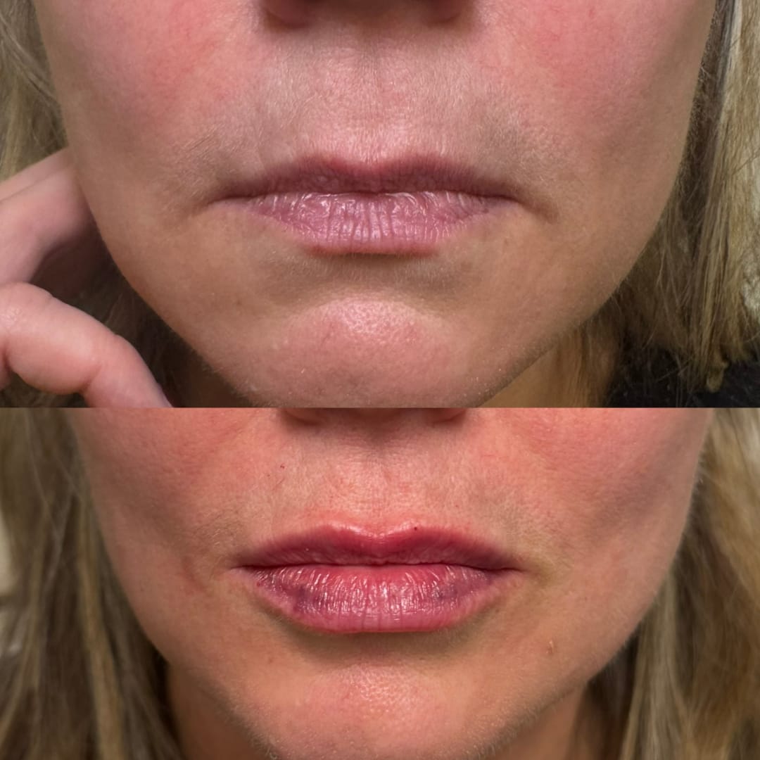 Lip Rejuvenation Before and After