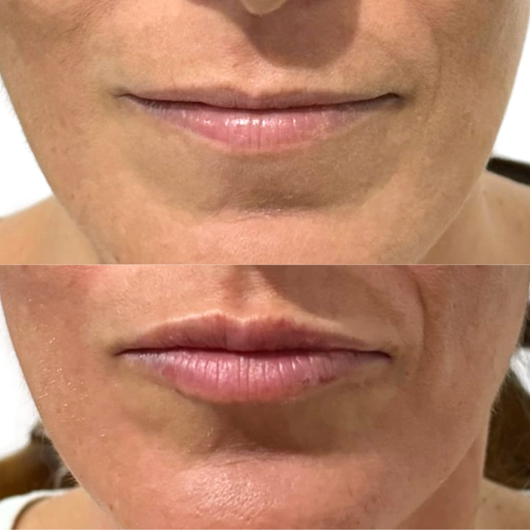 Lip Augmentation Before and After