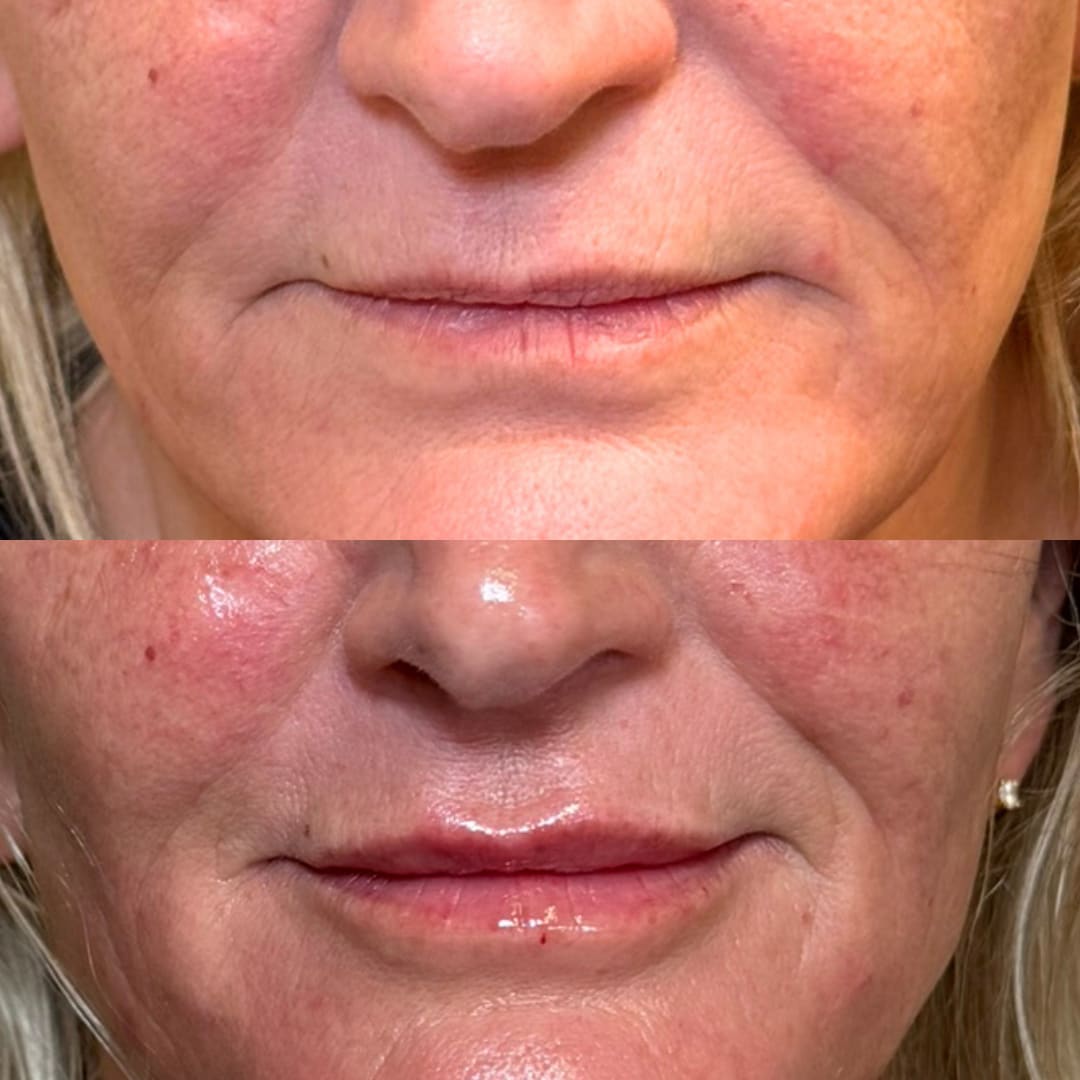 Lip Augmentation Before and After