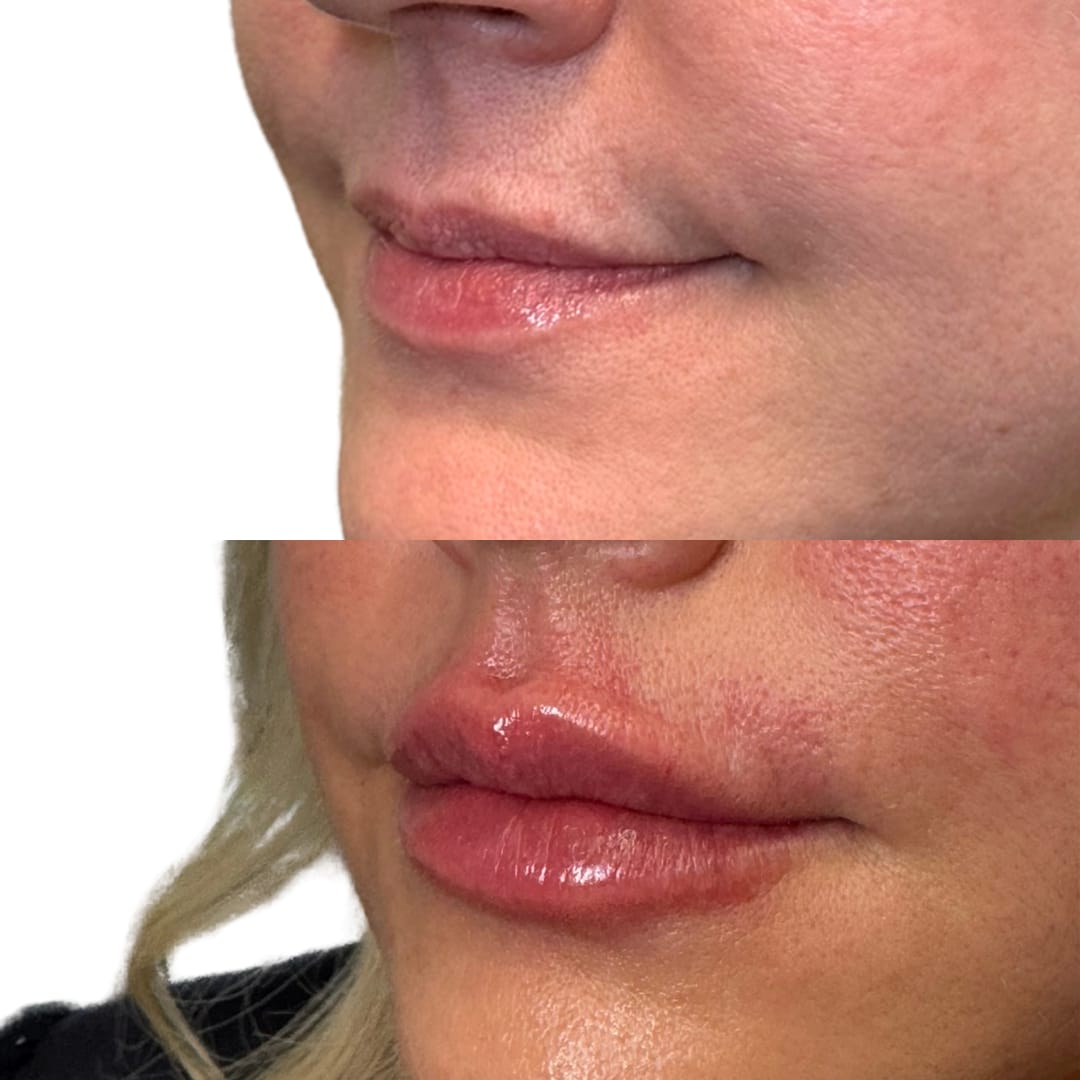 Lip Augmentation Before and After