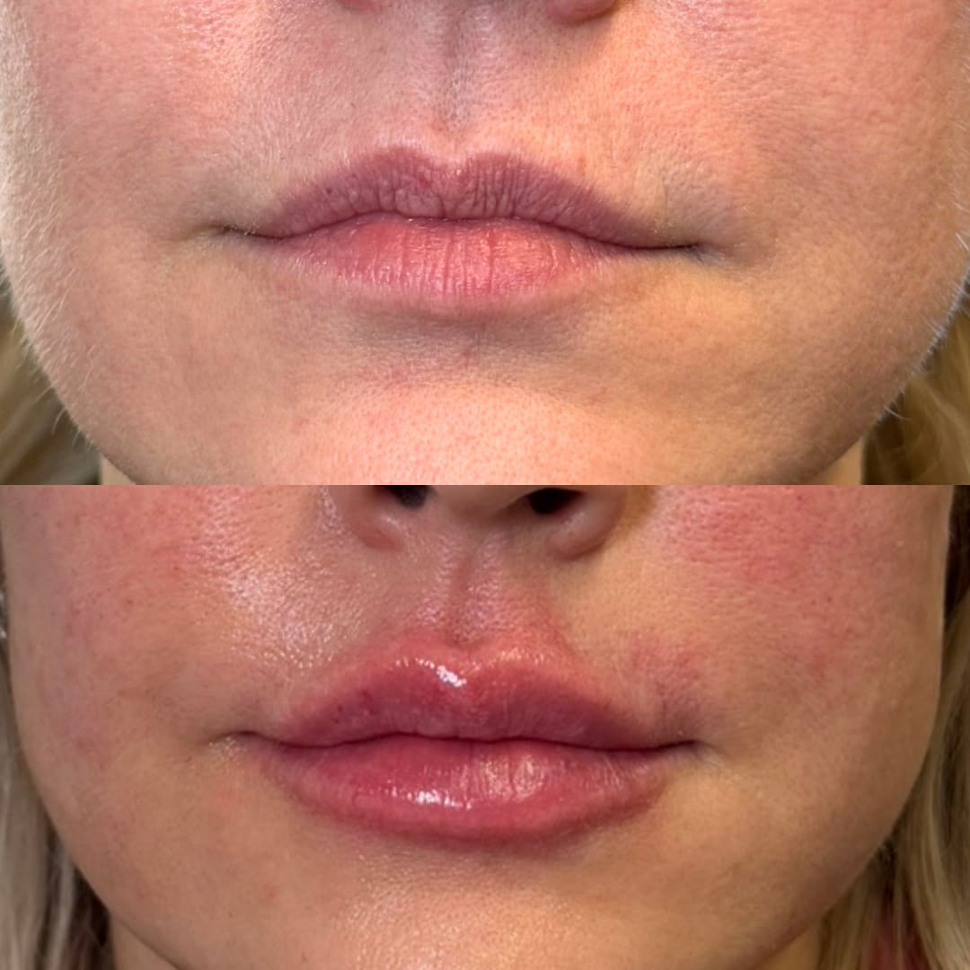 Lip Augmentation Before and After