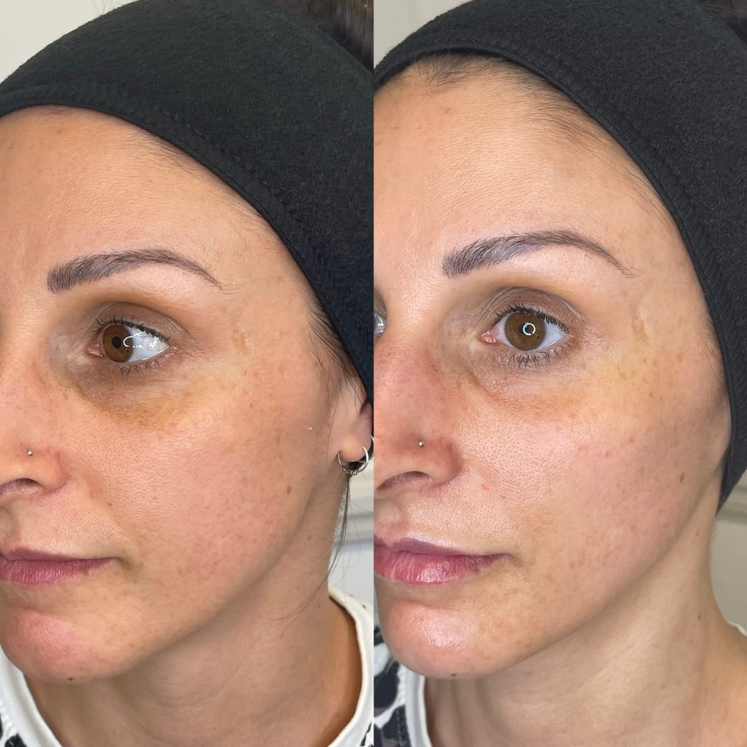 Cheek Before and After