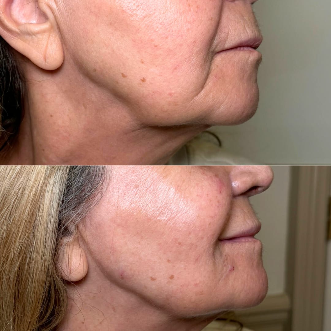 Jawline Rejuvenation Before and After