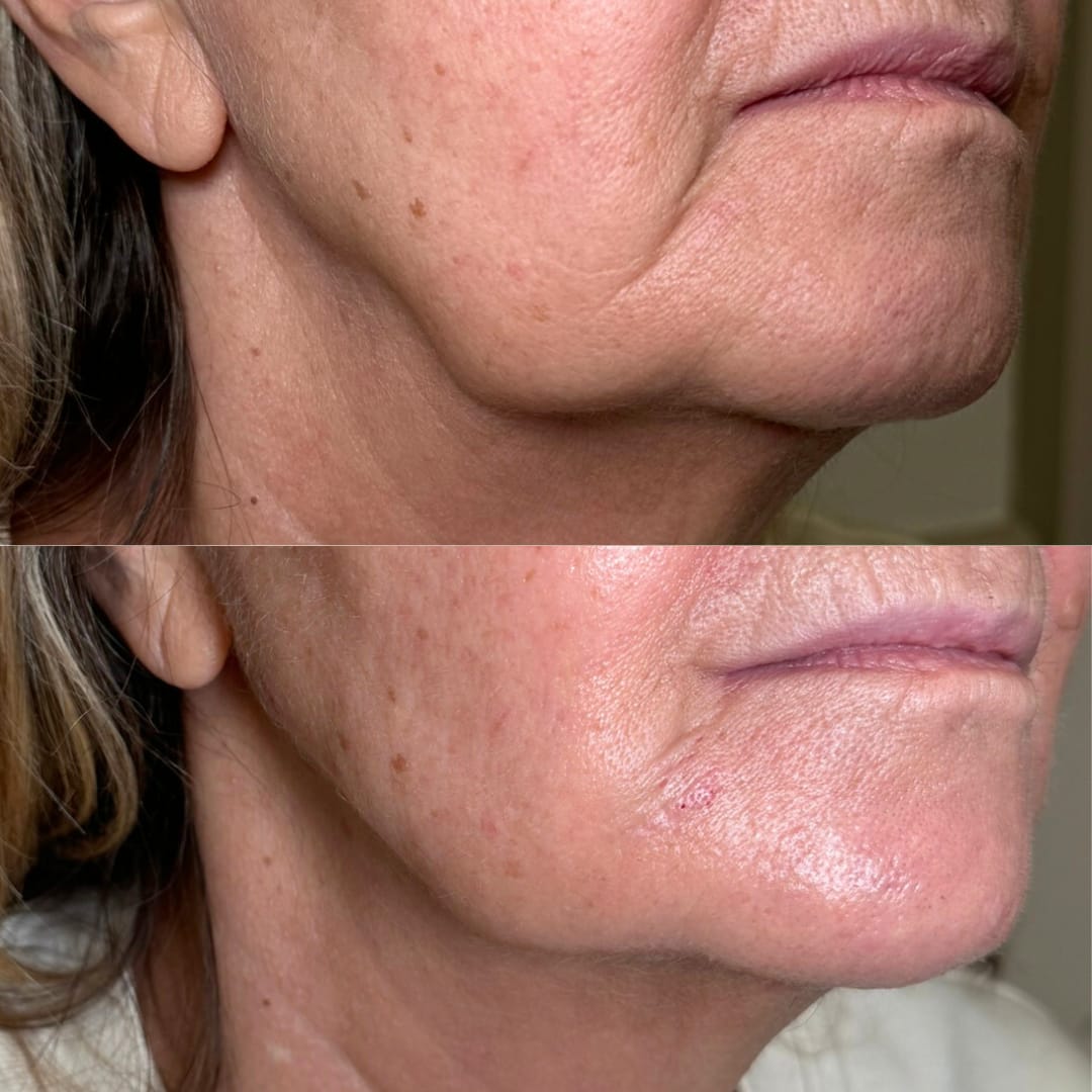 Jawline Rejuvenation Before and After