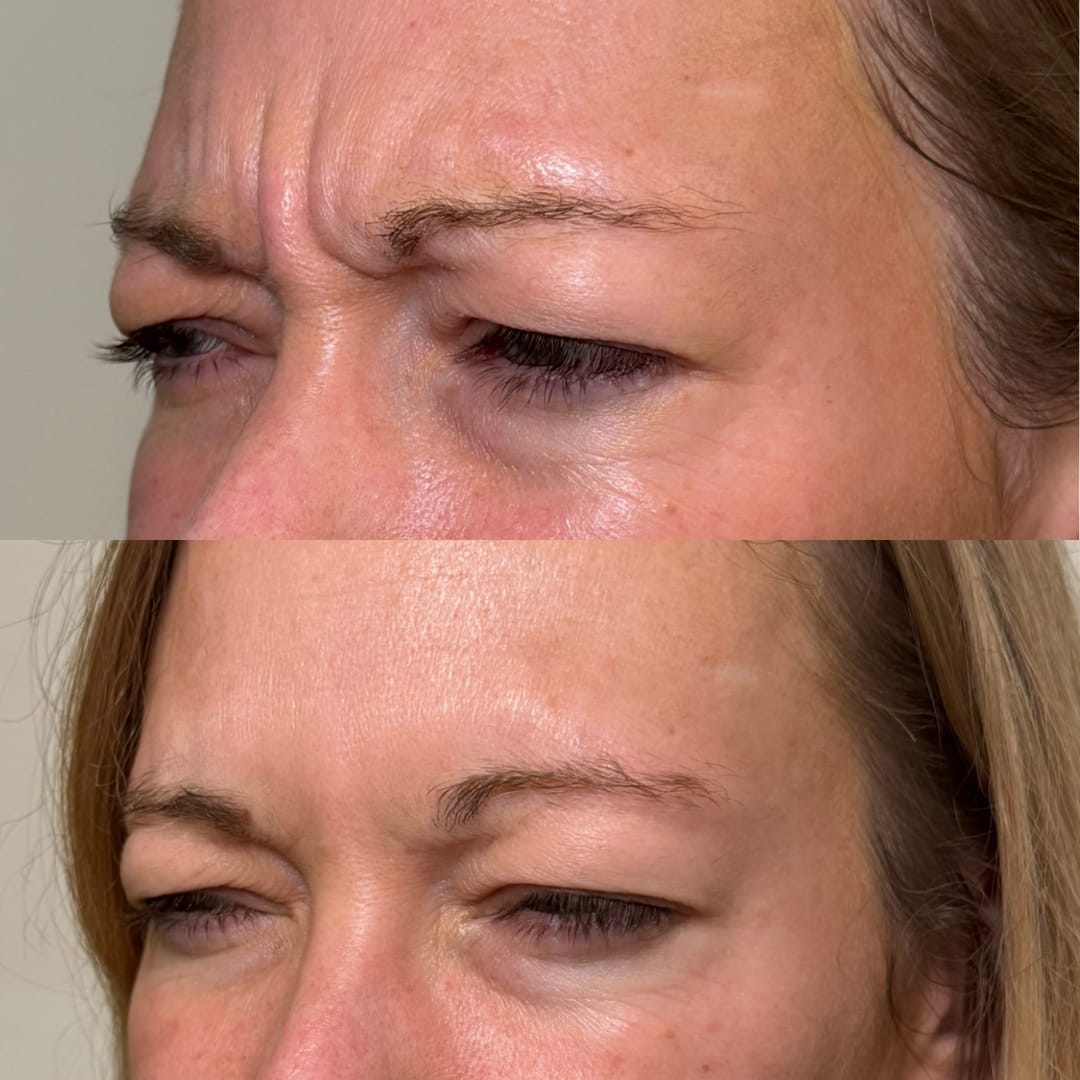 Frown Line Relaxation Before and After